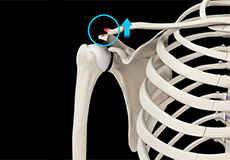 AC Joint Dislocation/Acromioclavicular Joint Dislocation