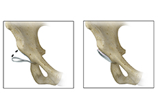 Acetabular Rim Trimming