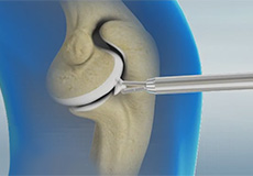 Arthroscopic Debridement of the Elbow