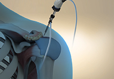 Arthroscopic Surgery