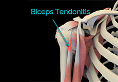 Bicep Tendon Rupture at Shoulder