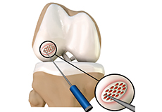 Cartilage Preservation Techniques