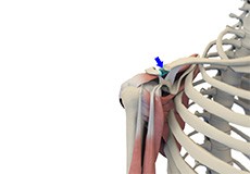 Distal Clavicle Excision