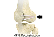 Medial Patellofemoral Ligament Reconstruction