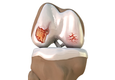 Osteoarthritis