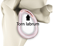 Shoulder Labral Tear