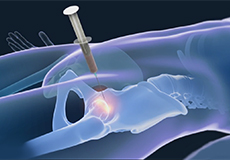 Stem Cell Therapy for Hip Injuries