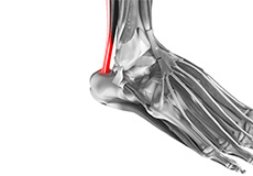 Tendinopathies