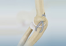 UCL Reconstruction (Tommy John Surgery)